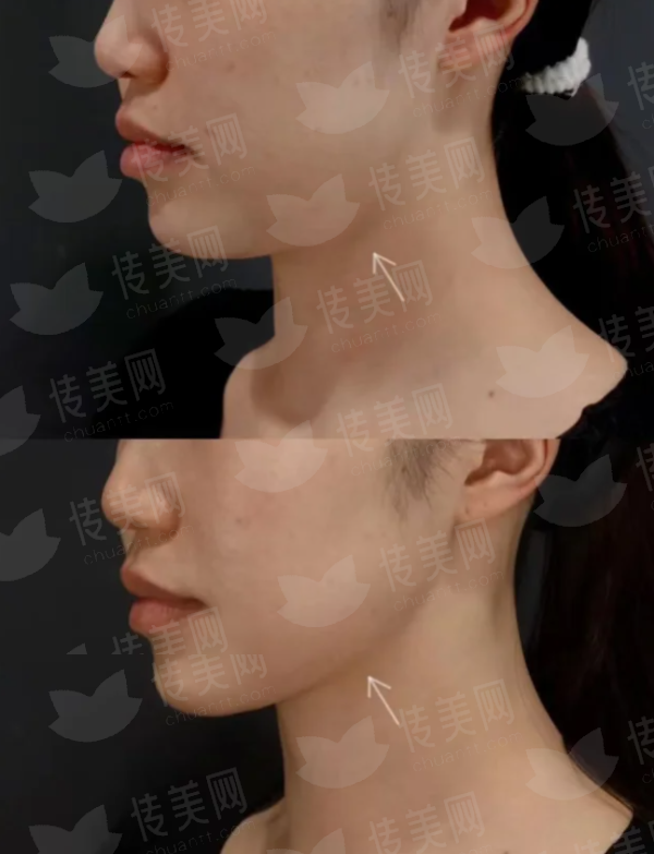 <strong>二、深入解析：提眉术的优点有哪些？</strong>