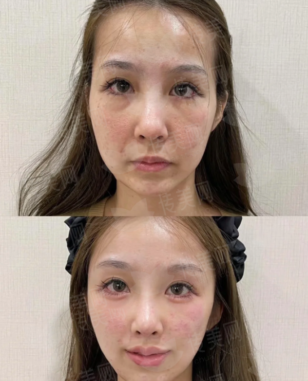 <strong>二、抚州梦婷医疗美容的隆鼻技术与医生如何？</strong>