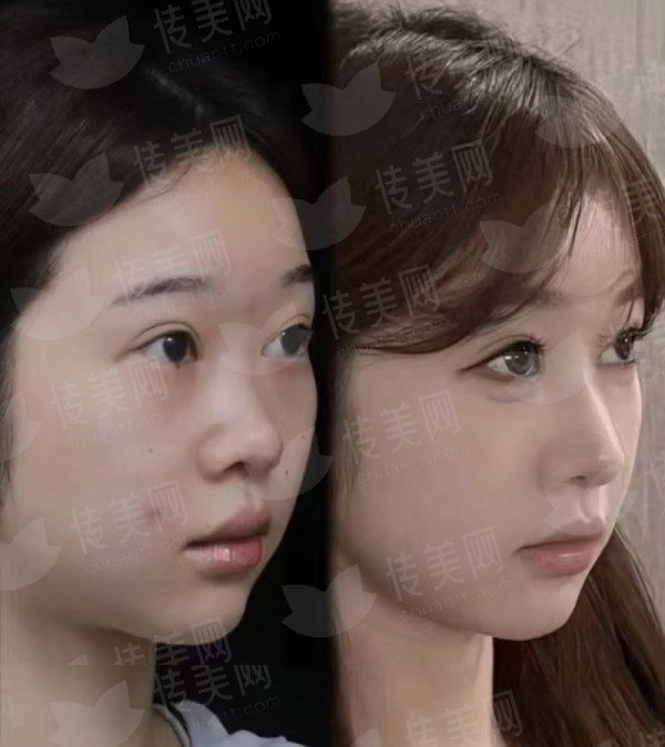 <strong>三、拉皮手术风险大吗？在广东深圳非凡医疗美容如何保护安心与成效？</strong>