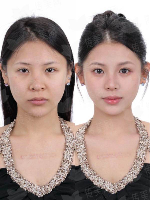 <strong>三、抚州梦婷医疗美容做吸脂的价格和流程是怎样的？</strong>