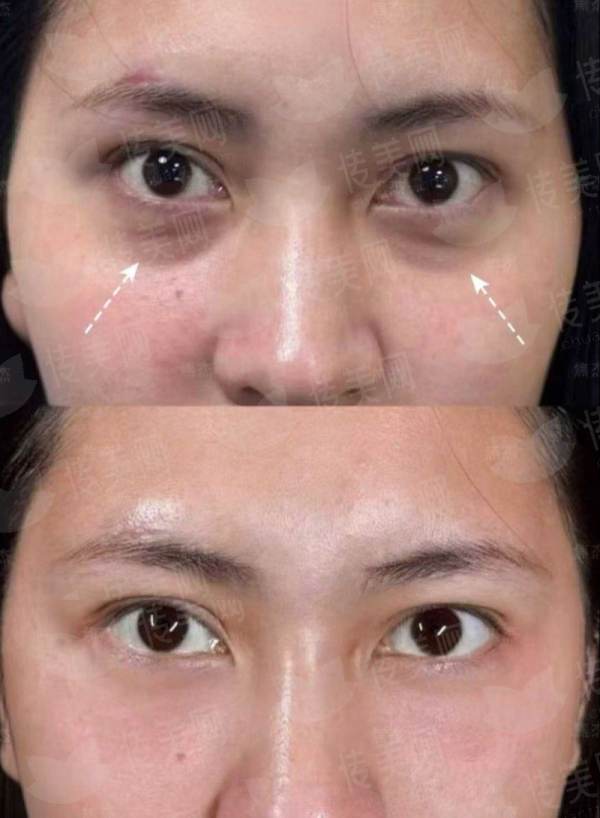 <strong>四、除了拉皮，还有别的选择吗？在广东深圳如何理性决策？</strong>