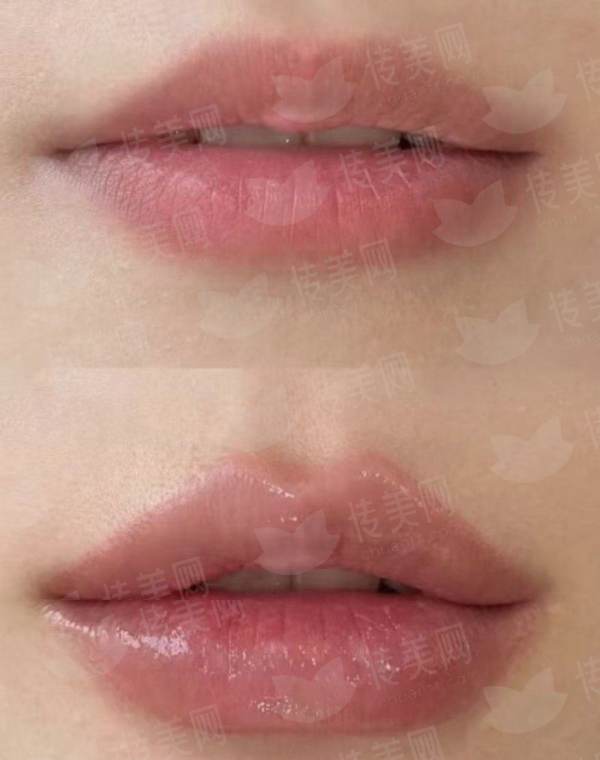 <strong>二、<strong>鼻翼缩小手术与非手术方式如何选择？</strong></strong>