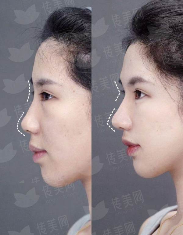 <strong>三、在平顶山星美医疗美容做全切双眼皮，价格和流程是怎样的？</strong>