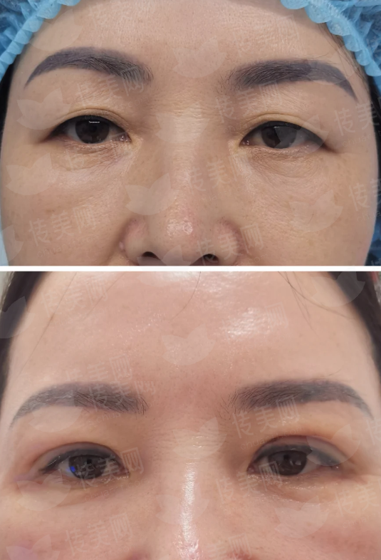 <strong>二、沈阳腾采医疗美容的吸脂手术安心如何保护？</strong>