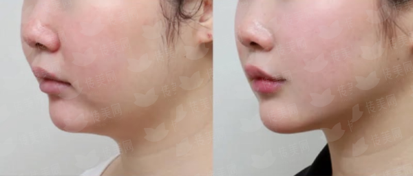 <strong>二、<strong>四川成都现代整形医院的乳房下垂矫正技术有何独到之处？</strong></strong>