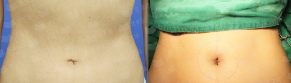 <strong>二、在安徽芜湖名姝医疗美容医院做吸脂，有没有后遗症？</strong>