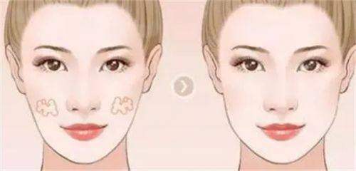 <strong>二、安徽芜湖名姝医疗美容的隆鼻方式有哪些？如何选择？</strong>