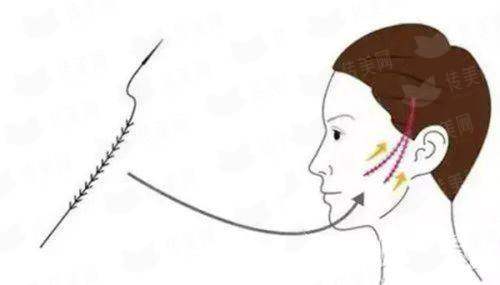 <strong>二、许昌正美韶华医疗整形的SMAS筋膜提升技术有何独到之处？</strong>