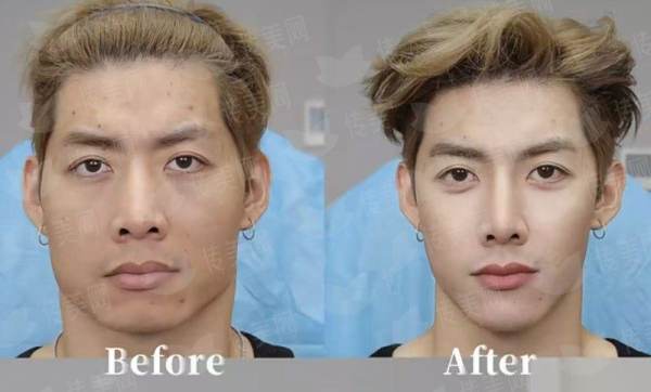 <strong>二、贵阳美和医疗美容医院的5V明星艺术面雕到底是什么？</strong>