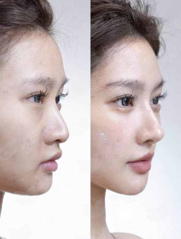 <strong>三、张强院长的肋骨鼻手术，有哪些具体的技术亮点？</strong>