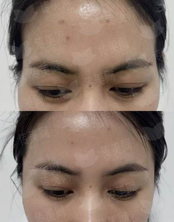 <strong>二、上海美莱医疗美容的眼修复技术好吗？</strong>