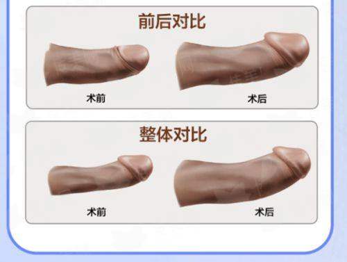 精工细作：北京嘉禾医疗美容王光复合隆胸的特色仪器与细节把控