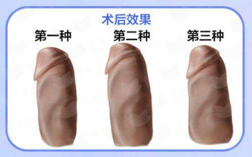深圳安美聚光黄志祥中面部提升：为何备受青睐？