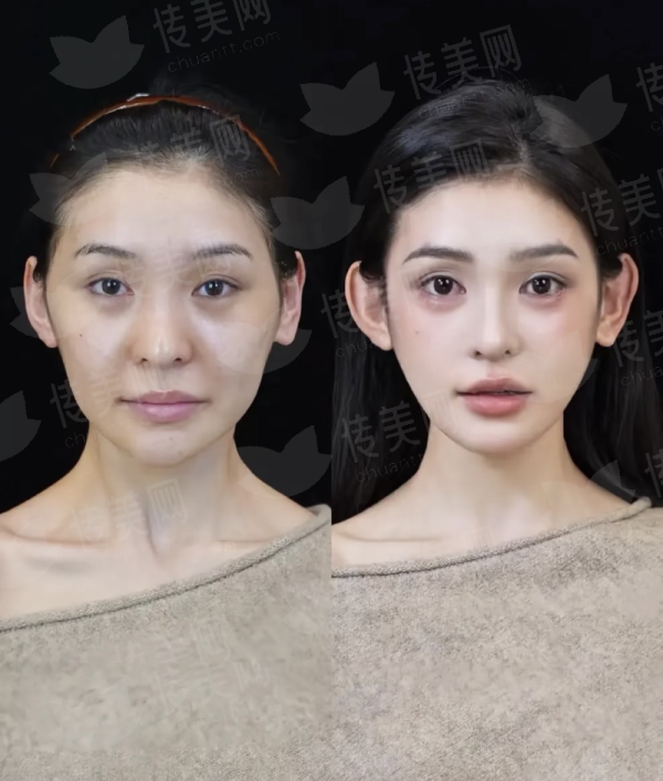 深圳安美聚光黄志祥中面部提升的特色治疗方式