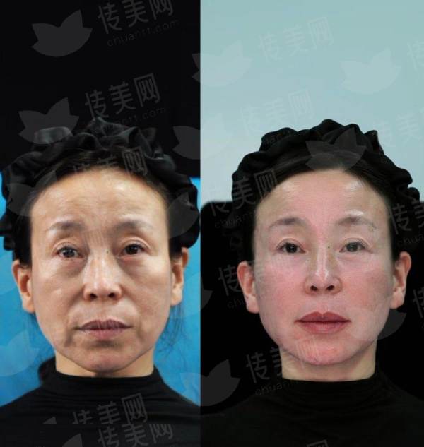 赤峰雅飞悦己刘德顺医生双眼皮修复怎么样？价格表与案例解析-新颜智尚小程序一键预约！