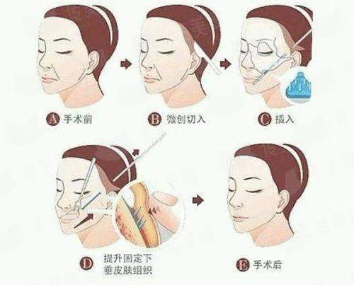 北京纯脂隆胸找王子谦医生靠谱吗？价格表&案例分享，新颜智尚小程序一键预约！