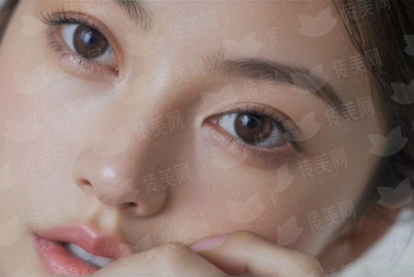 惠州赫铂医疗美容双眼皮手术的常见术式选择